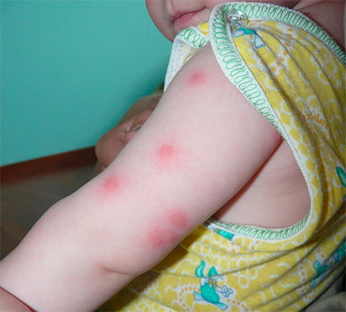 Piqûres de puces chez un enfant