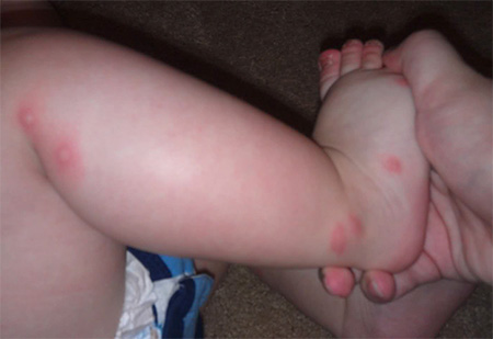 Même un petit nombre de piqûres de punaises de lit peut être dangereux pour les tout-petits Même un petit nombre de piqûres de punaises de lit peut être dangereux pour les tout-petits