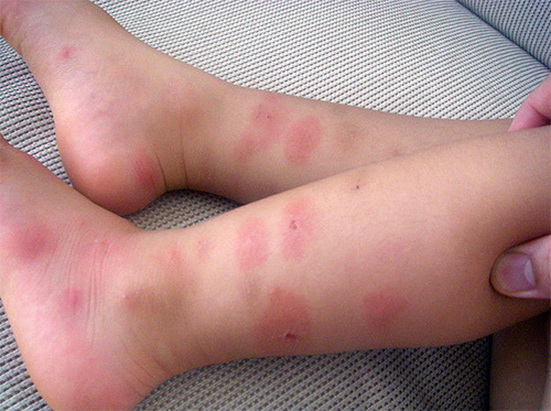 Les punaises de lit ont piqué les jambes d'un enfant Les punaises de lit ont piqué les jambes d'un enfant
