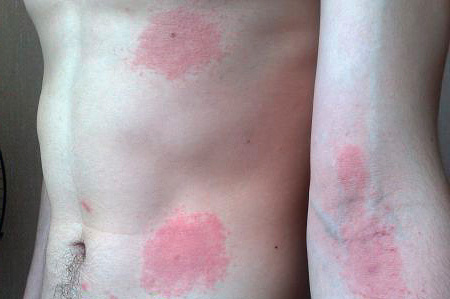 Dermatophiliase Dermatophiliase