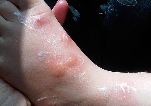 Le gel peut généralement être appliqué sur les plaies suintantes causées par les piqûres Le gel peut généralement être appliqué sur les plaies suintantes causées par les piqûres