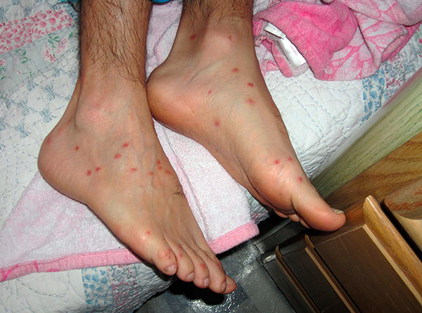 Si ces piqûres sont grattées, il existe un risque d'introduire une infection dans la plaie. Si ces piqûres sont grattées, il existe un risque d'introduire une infection dans la plaie.