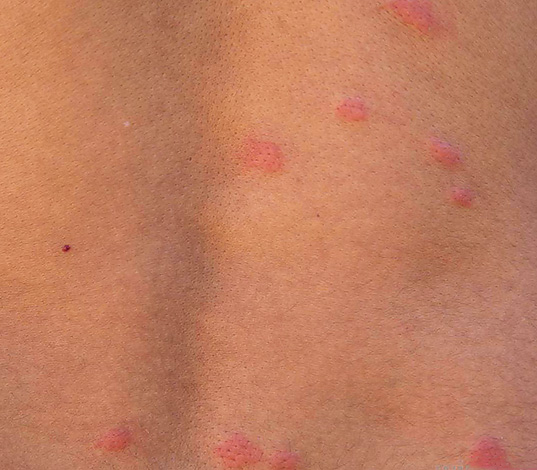 Piqûres de puces sur le dos Piqûres de puces sur le dos
