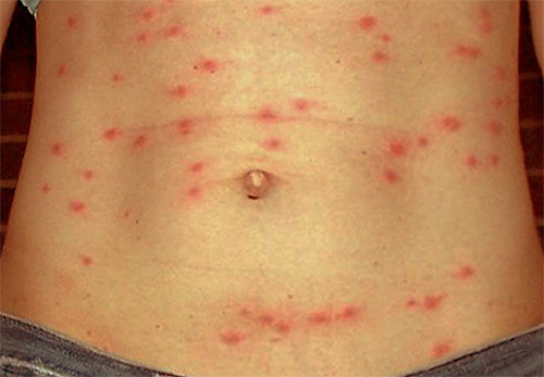 Les poux sont des vecteurs du typhus, dont l'un des symptômes est une éruption cutanée sur le corps Les poux sont des vecteurs du typhus, dont l'un des symptômes est une éruption cutanée sur le corps