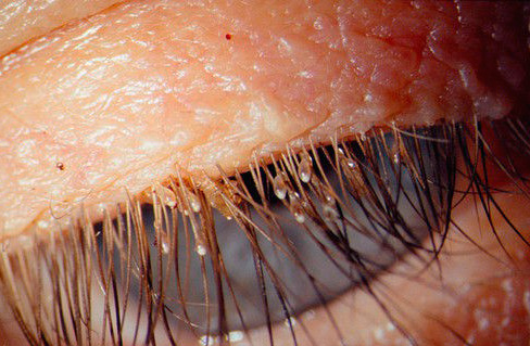 Et voici à quoi ressemblent les lentes sur les cils d'une personne Et voici à quoi ressemblent les lentes sur les cils d'une personne