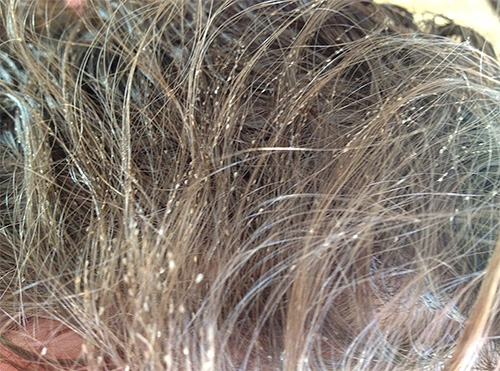 Voilà à quoi ressemblent les cheveux en cas d'infestation sévère de la tête par les poux. Voilà à quoi ressemblent les cheveux en cas d'infestation sévère de la tête par les poux.