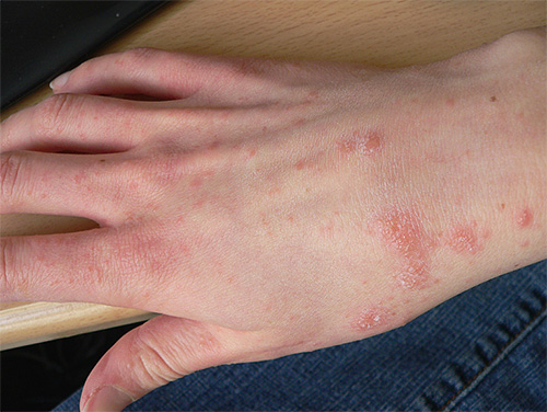 Éruption cutanée sur les mains due à la gale Éruption cutanée sur les mains due à la gale