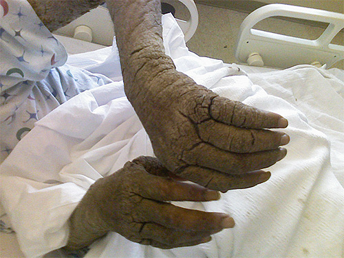 Photo des mains d'une personne atteinte de gale norvégienne Photo des mains d'une personne atteinte de gale norvégienne