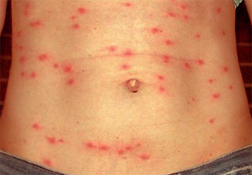 Manifestations du typhus exanthématique sur la peau de l'abdomen Manifestations du typhus exanthématique sur la peau de l'abdomen
