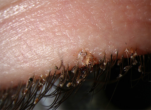 Poux du pubis et leurs lentes sur les cils d'une personne Poux du pubis et leurs lentes sur les cils d'une personne