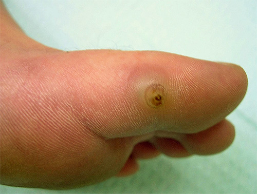Piqûre de puce de sable sur un orteil Piqûre de puce de sable sur un orteil