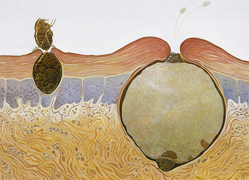 L'image montre comment la femelle de la puce de sable se comporte dans le corps humain L'image montre comment la femelle de la puce de sable se comporte dans le corps humain