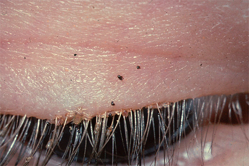 Une autre photo où l'on peut observer les poux et les lentes sur les cils d'une personne Une autre photo où l'on peut observer les poux et les lentes sur les cils d'une personne