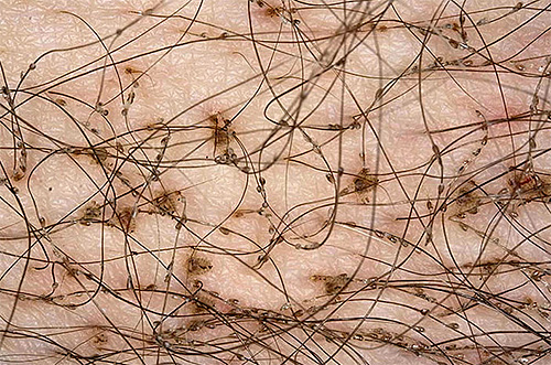 Outre les poux du pubis eux-mêmes, on peut également distinguer de nombreuses lentes sur les poils. Outre les poux du pubis eux-mêmes, on peut également distinguer de nombreuses lentes sur les poils
