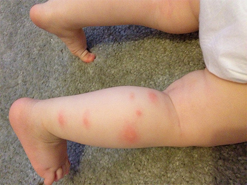 Piqûres de puces sur la jambe d'un enfant Piqûres de puces sur la jambe d'un enfant