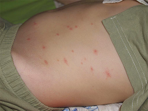 Une réaction allergique chez un enfant à une piqûre de puce peut être beaucoup plus prononcée que chez un adulte. Une réaction allergique chez un enfant à une piqûre de puce peut être beaucoup plus prononcée que chez un adulte.