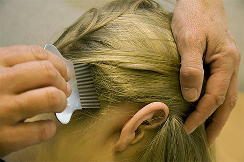 Les poux et les lentes sont retirés des cheveux mèche par mèche. Les poux et les lentes sont retirés des cheveux mèche par mèche.
