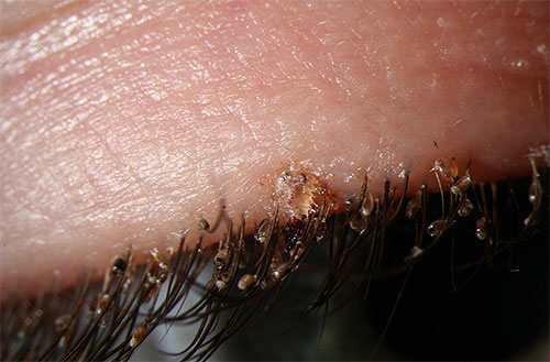 En cas d'infestation par les poux pubiens, on peut parfois les voir même sur les cils.