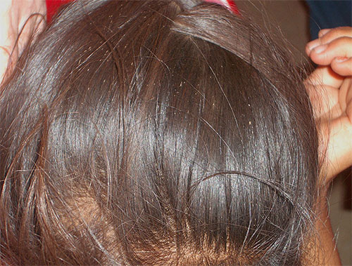 Les lentes sur les cheveux ressemblent à un amas de points blancs.