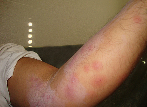 Les premières piqûres de punaises de lit dans un appartement sont souvent prises pour des piqûres de moustiques ou une allergie Les premières piqûres de punaises de lit dans un appartement sont souvent prises pour des piqûres de moustiques ou une allergie