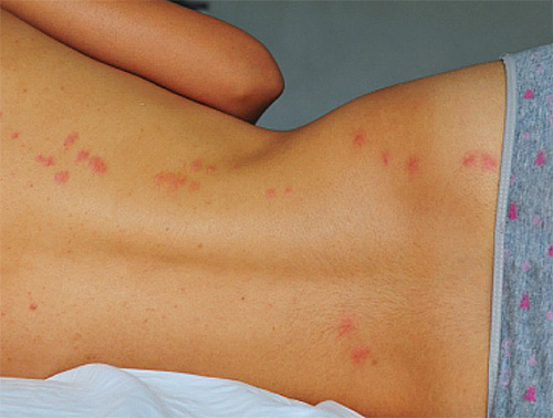 Les piqûres de punaises sont généralement disposées en chaînes sur le corps Les piqûres de punaises sont généralement disposées en chaînes sur le corps