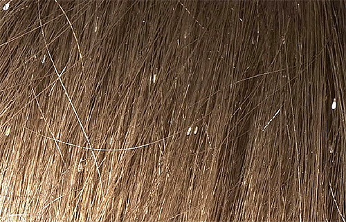 Les lentes dans les cheveux - un symptôme caractéristique de l'infestation par les poux
