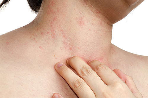 Parfois, une allergie soudaine peut indiquer la présence de poux.