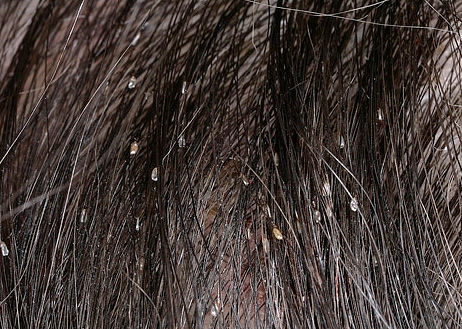 Les lentes deviennent immédiatement visibles sur les cheveux foncés