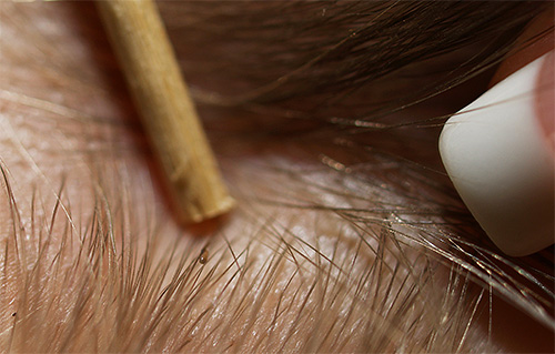 La taille des lentes est si petite qu'elles passent facilement entre les dents des peignes ordinaires