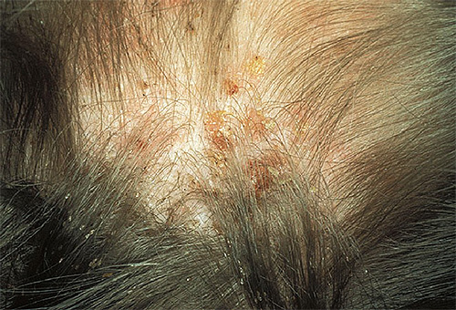 L'huile d'anis est inutile contre les poux eux-mêmes, mais peut aider à soulager les démangeaisons et les pustules cutanées après les piqûres.
