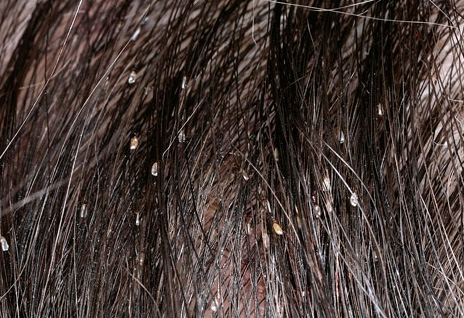 Les lentes sont plus visibles sur les cheveux que les poux eux-mêmes, mais elles ne peuvent bien sûr pas piquer. Les lentes sont plus visibles sur les cheveux que les poux eux-mêmes, mais elles ne peuvent bien sûr pas piquer.