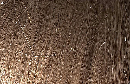 Les lentes de couleur blanchâtre sont particulièrement visibles sur les cheveux foncés Les lentes de couleur blanchâtre sont particulièrement visibles sur les cheveux foncés