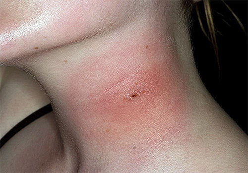 Au site de la piqûre, un œdème et une inflammation apparaissent presque immédiatement.