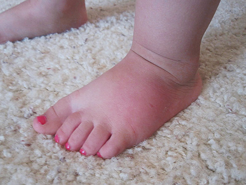Les conséquences des piqûres de guêpes chez les enfants se limitent généralement à une réaction locale sous forme d'un léger gonflement et de douleur. Les conséquences des piqûres de guêpes chez les enfants se limitent généralement à une réaction locale sous forme d'un léger gonflement et de douleur.