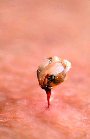 La photo montre un dard d'abeille laissé par l'insecte dans la peau humaine. La photo montre un dard d'abeille laissé par l'insecte dans la peau humaine.