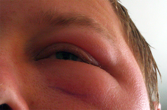 Exemple d'œdème allergique du visage après une piqûre d'abeille. Exemple d'œdème allergique du visage après une piqûre d'abeille