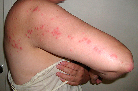 Voici à quoi ressemble une traînée caractéristique de piqûres de punaises de lit sur le corps de leur victime. Voici à quoi ressemble une traînée caractéristique de piqûres de punaises de lit sur le corps de leur victime.
