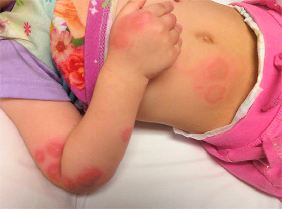 Cette photo montre les traces de piqûres de punaises de lit sur un enfant Cette photo montre les traces de piqûres de punaises de lit sur un enfant
