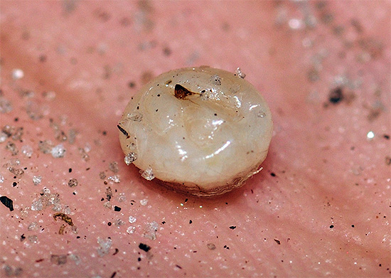 Et voici à quoi ressemble une femelle de puce des sables extraite de la peau, pleine d'œufs. Et voici à quoi ressemble une femelle de puce des sables extraite de la peau, pleine d'œufs.