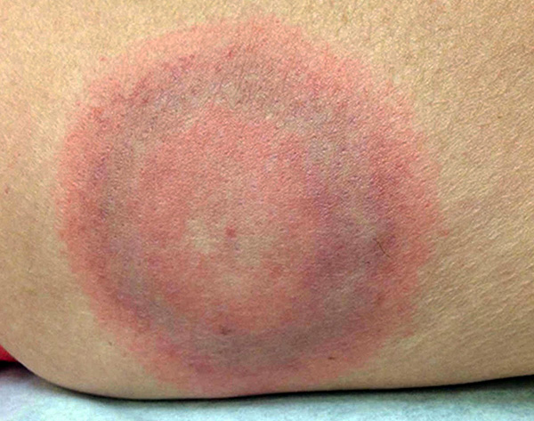 Cette tache (érythème annulaire) est le premier signe d'une infection par la borréliose de Lyme. Cette tache (érythème annulaire) est le premier signe d'une infection par la borréliose de Lyme.