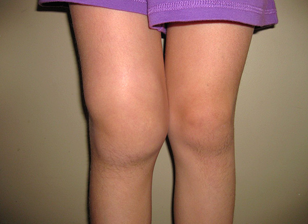 L'arthrite de Lyme entraîne parfois une atteinte grave des grosses articulations. L'arthrite de Lyme entraîne parfois une atteinte grave des grosses articulations.