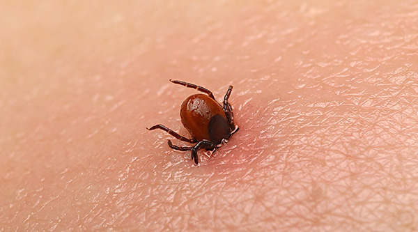 Lors de la morsure, la tique peut s'enfoncer assez profondément dans la peau - la tête du parasite se trouve souvent entièrement dans la plaie.