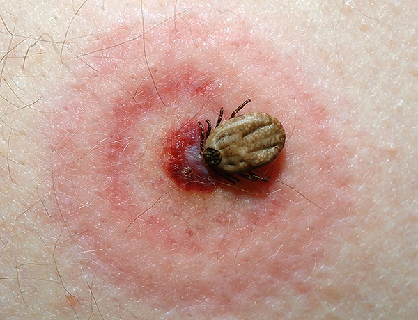 Dans certains cas, le parasitisme des tiques entraîne le développement de maladies infectieuses graves chez l'homme et les animaux (encéphalite à tiques, borréliose, etc.). Dans certains cas, le parasitisme des tiques entraîne le développement de maladies infectieuses graves chez l'homme et les animaux (encéphalite à tiques, borréliose, etc.).