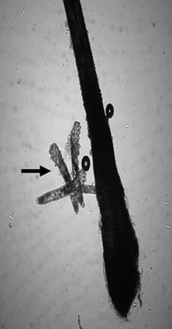 Demodex folliculorum au niveau du follicule pileux. Demodex folliculorum au niveau du follicule pileux.