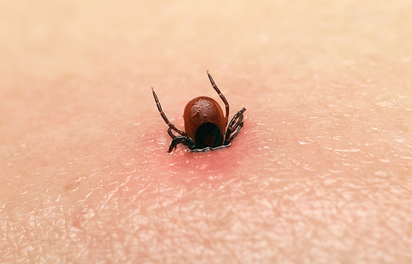 Les particularités des premiers soins en cas de morsure de tique... Les particularités des premiers soins en cas de morsure de tique...
