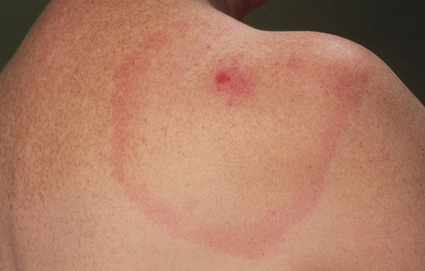 Même en l'absence de symptômes évidents de la maladie, il faut surveiller attentivement l'état de la personne mordue pendant au moins 2 mois à partir du moment de la morsure de tique. Même en l'absence de symptômes évidents de la maladie, il faut surveiller attentivement l'état de la personne mordue pendant au moins 2 mois à partir du moment de la morsure de tique.
