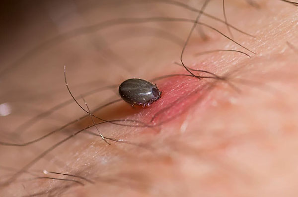 Les téguments du corps de la tique sont mous, et donc comprimer fortement le parasite gorgé est dangereux en raison du risque d'expulser du sang et de la salive déjà infectés dans la plaie.