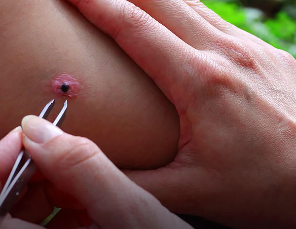 À l'endroit où les pièces buccales du parasite sont restées dans les tissus, une inflammation et une suppuration commenceront. À l'endroit où les pièces buccales du parasite sont restées dans les tissus, une inflammation et une suppuration commenceront.
