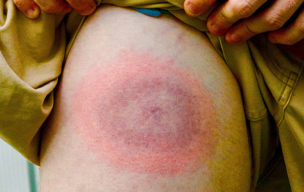 L'érythème migrant annulaire est un signe d'infection par la borréliose de Lyme.