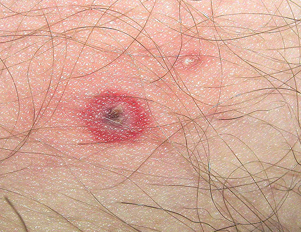 Les rougeurs et les démangeaisons au niveau de la morsure de tique ne sont pas encore des signes d’infection. Les rougeurs et les démangeaisons au niveau de la morsure de tique ne sont pas encore des signes d’infection.
